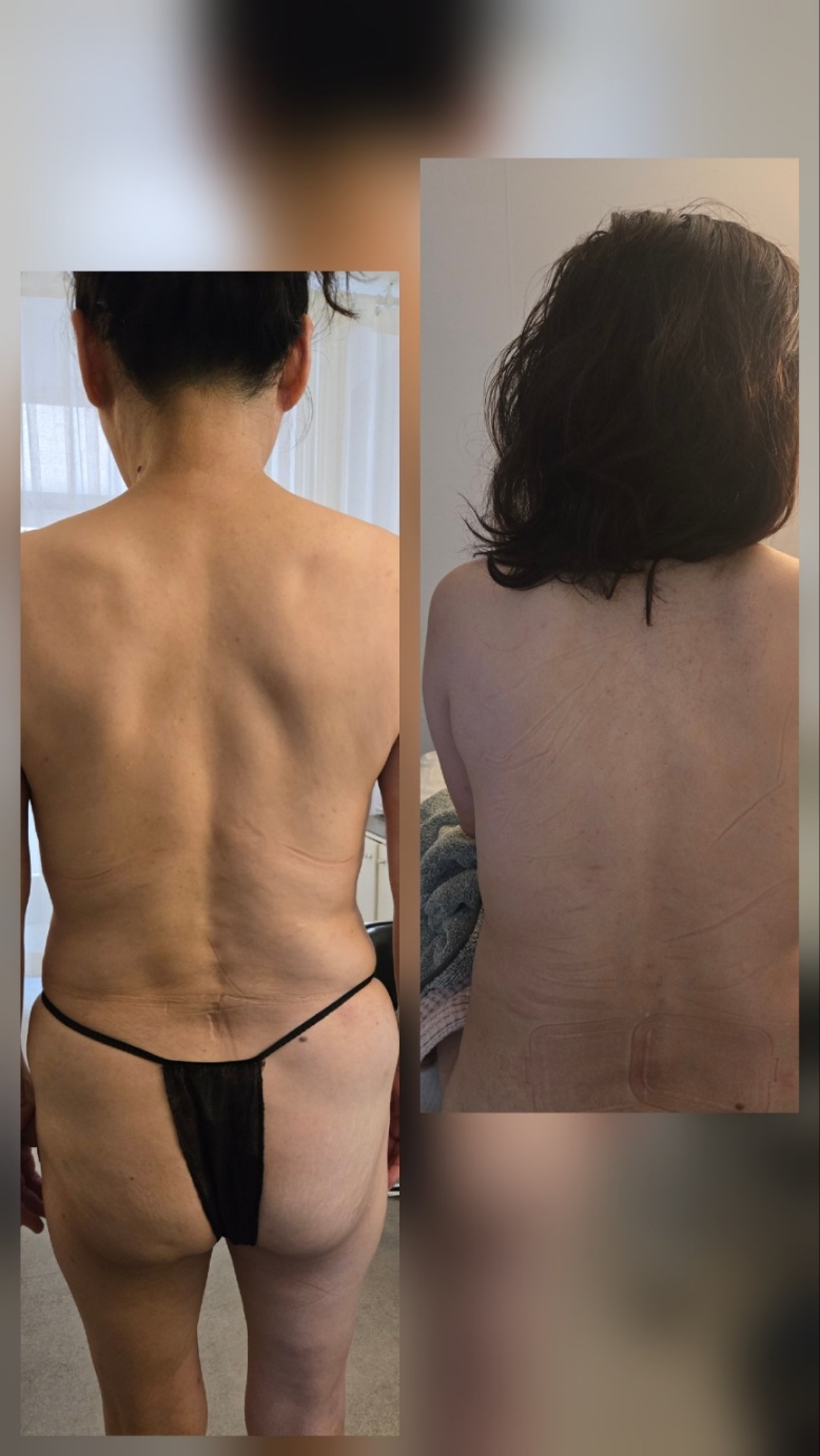 척추 정렬 변화 사례 2