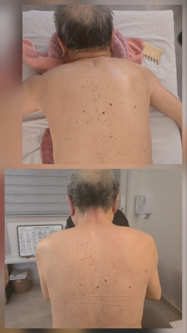 등·어깨 관리 진행 사례 8