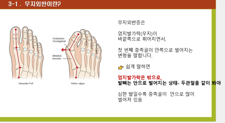 무지외반증 교정 스트레칭