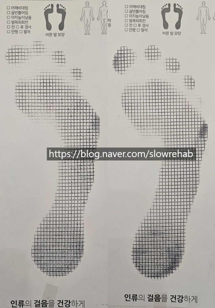 족저근막염 발아치 교정