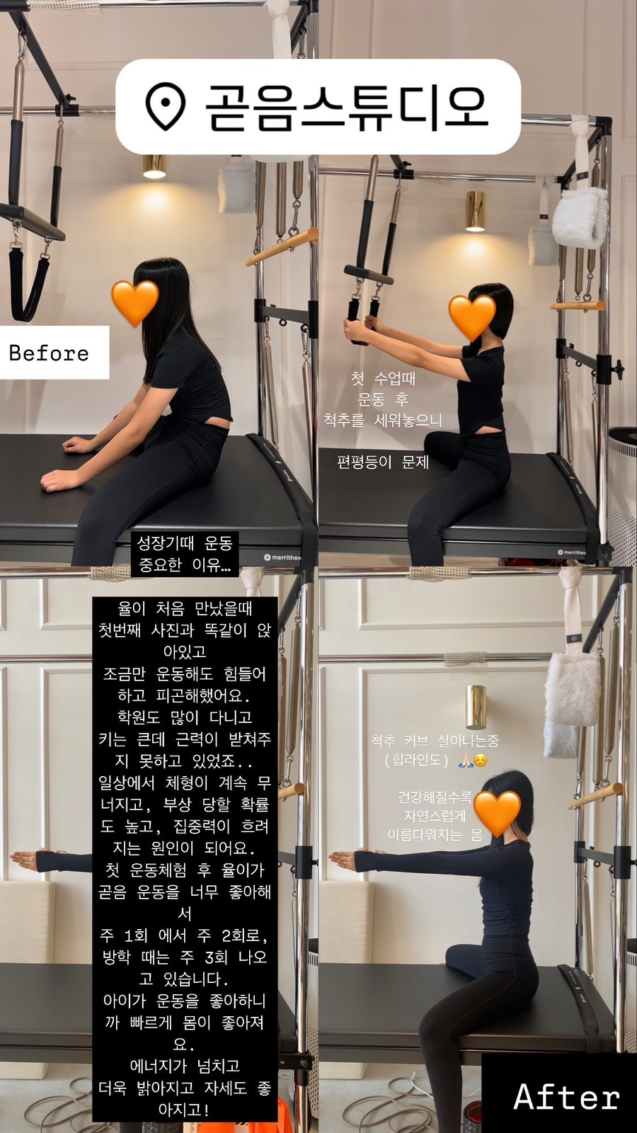비포 애프터 — 척추측만 교정 후기