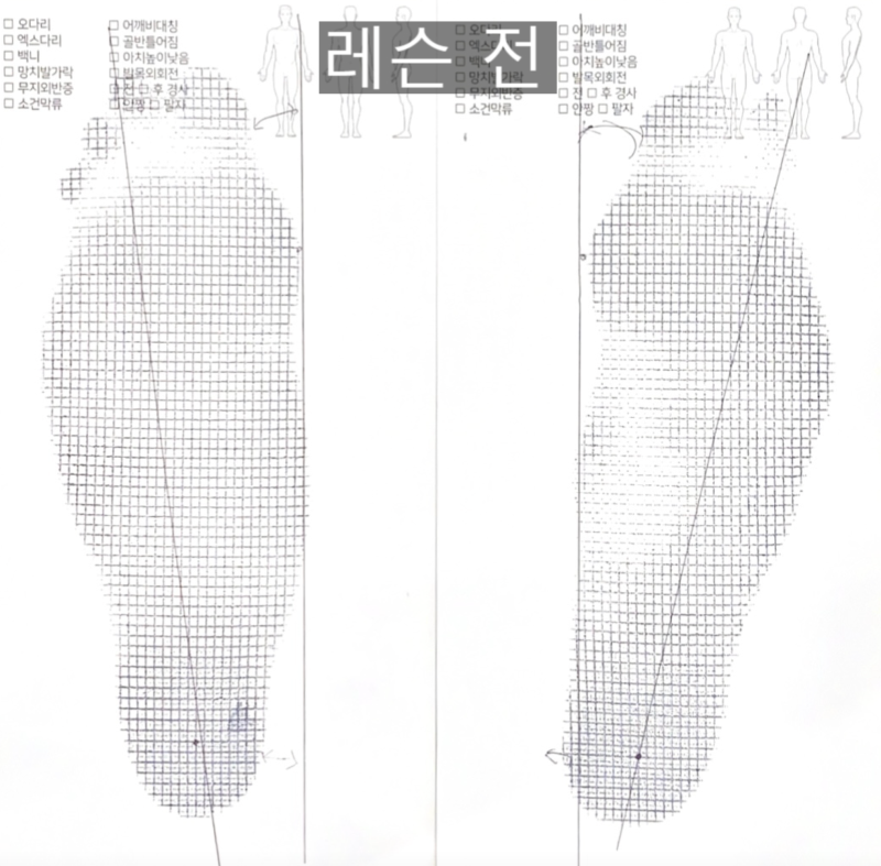 무릎 통증 극복과 족문검사